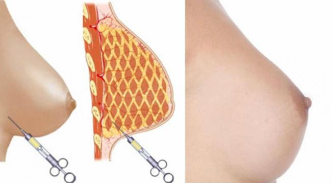 Nueva-tecnica-para-aumentar-el tamano-de-los-senos-sin-usar-silicona-2